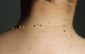 skin tags neck,